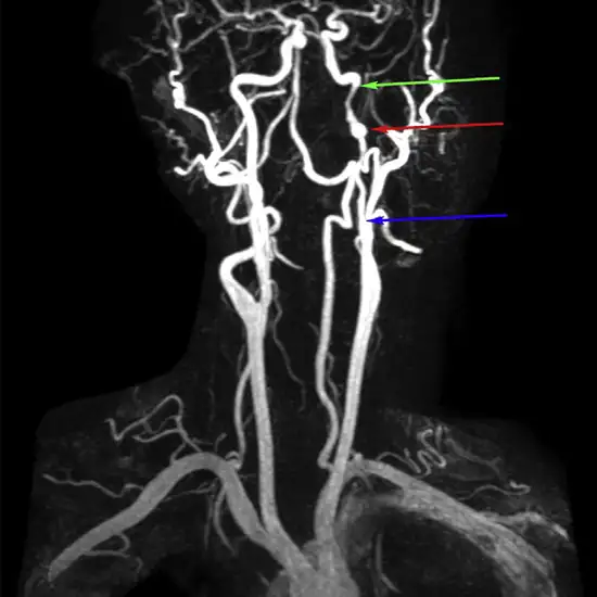 Carotid MR Angiography